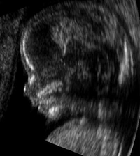 Embryo 14 Wochen alt | Ultraschall - Profilaufnahme eines 14 Wochen alten Embryos. Quecksilber kann schon beim Erwachsenen Schäden vor allem an Nieren und Zentralnervensystem hervorrufen. Wie stark muss erst die Einwirkung bei sich ausbildenden Strukturen sein! Nicht umsonst dürfen Schwangere keine Quecksilberfüllungen mehr erhalten. Embryo 14 Wochen alt