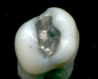 Zahnfüllung aus Amalgam | Amalgam hat als Material für Zahnfüllungen unbestrittene Vorteile. Es lässt sich sehr gut verarbeiten und schließt dicht ab. Allerdings verdampft das darin enthaltene Quecksilber langsam. Über die die von Amalgam ausgelösten Schädigungen streiten sich die Gelehrten. Komisch: Im Mund ist es nach Ansicht vieler (auch Zahnärzte) ungiftig, außerhalb des Mundes muss es als giftiges Schwermetall entsorgt werden!?! Ach ja, Schwangere dürfen es gar nicht gelegt bekommen. Warum wohl? Zahnfüllung aus Amalgam